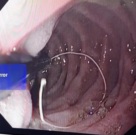 Chiếc kim kèm đoạn cước được các bác sĩ nội soi lấy ra