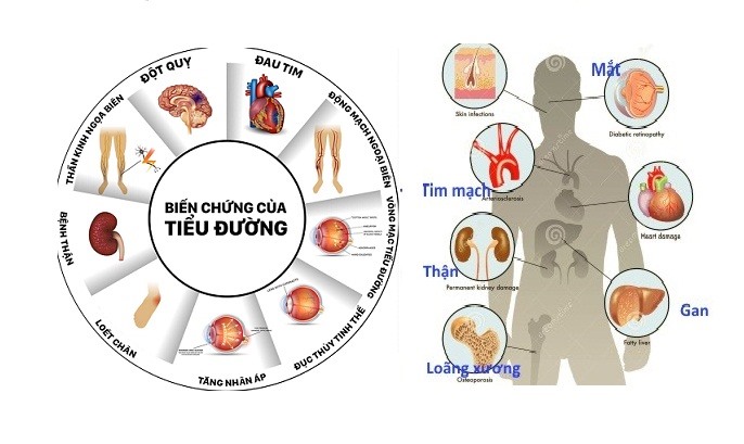 Căn bệnh tiểu đường được xem là “sát thủ trầm lặng“.
