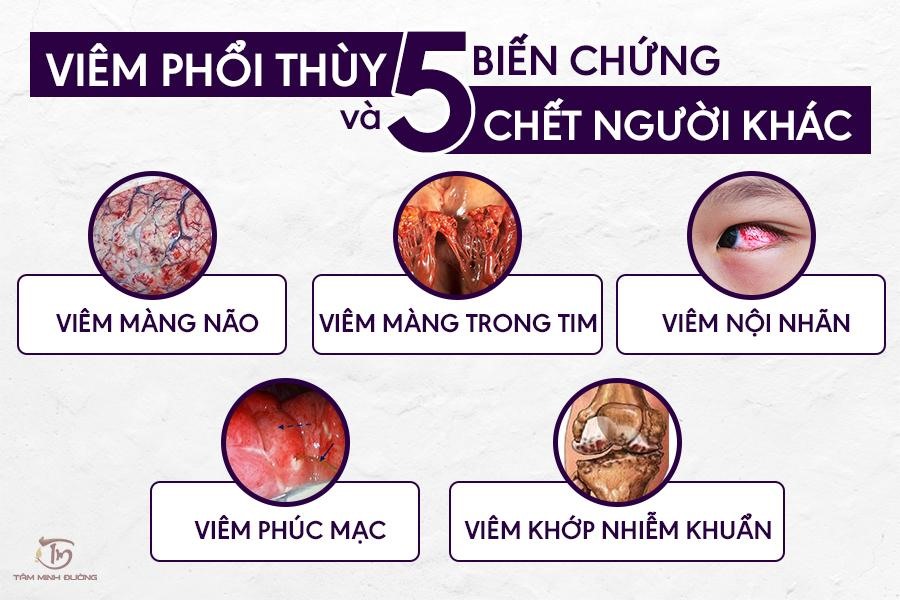 Bien-Chung-Viem-Phoi
