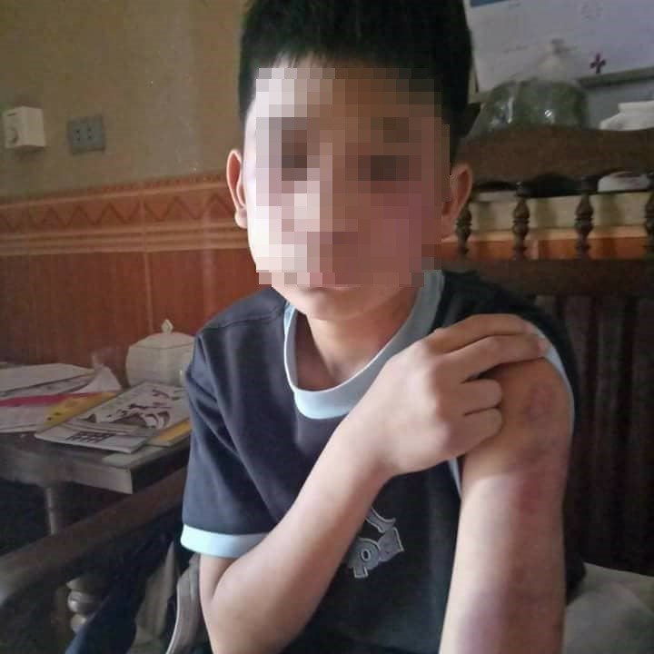 Cháu H bị bố ruột, mẹ kế bạo hành.