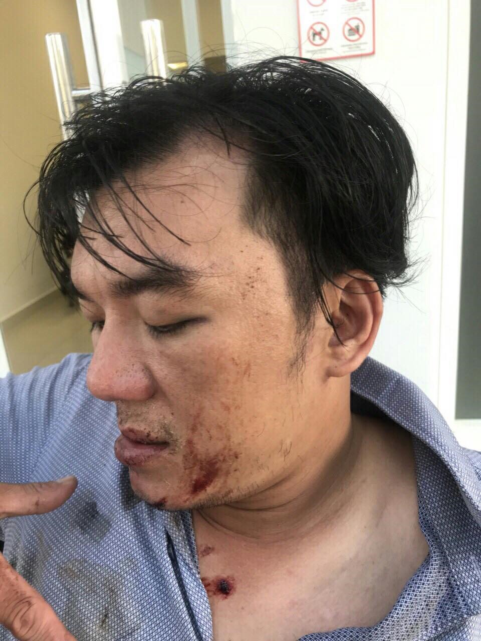 Ông Hiếu bị đa chấn thương vùng mặt, chấn thương vùng mang tai. Ảnh: N.T