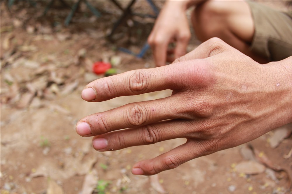 Bàn tay của những người thợ nuôi ong chi chít những vết ong đốt