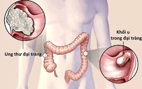 Ảnh đồ họa vị trí ung thư đại trực tràng do BS cung cấp