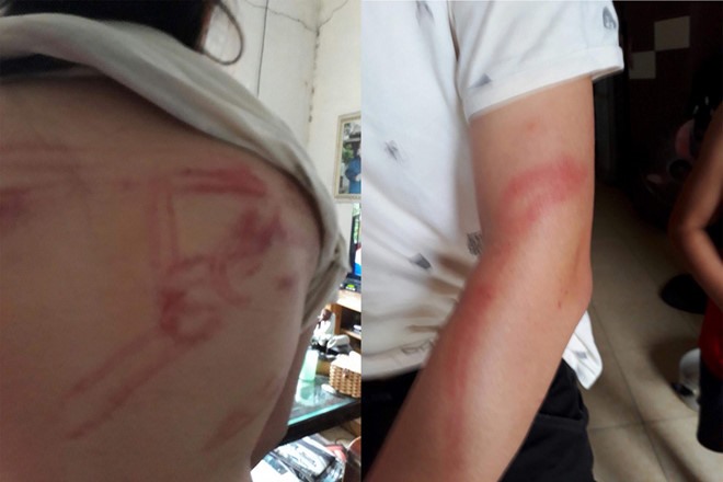 Những vết lằn còn mới nguyên khi các bé được giải cứu. Ảnh: Quang Trung