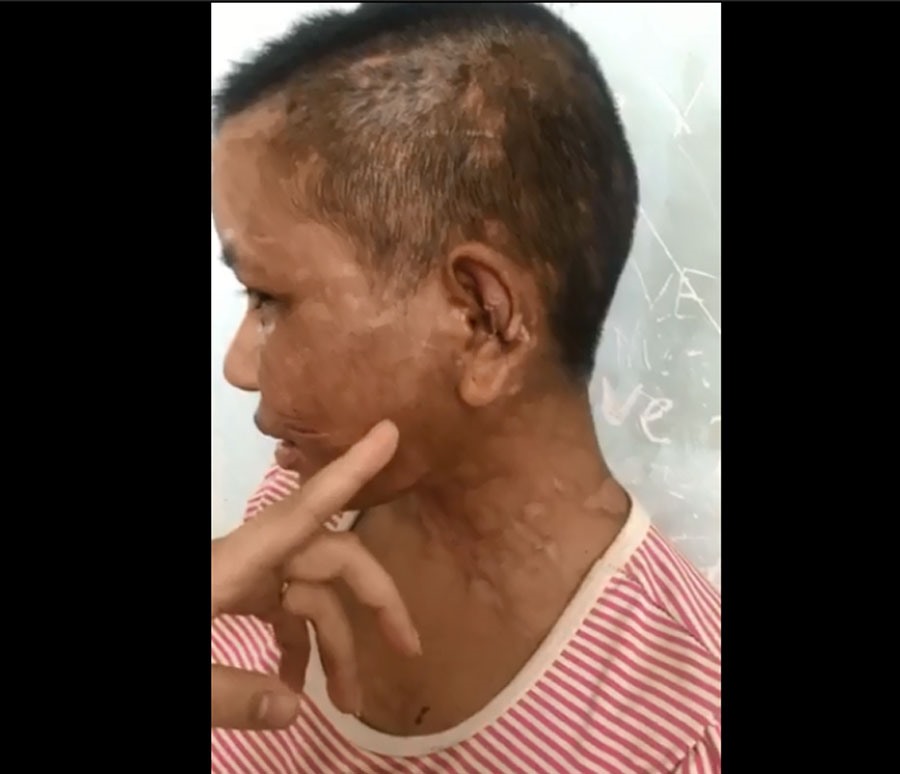 Khuôn mặt Y Nhiêu chi chít sẹo do bị tra tấn bởi kìm, bàn là, dao lam.