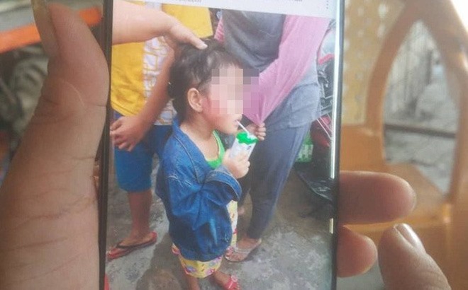 Bé D bị hành hung dẫn đến thương tích tím mặt. Ảnh người nhà nạn nhân cung cấp.