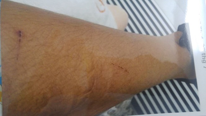 Một vết xây xác khác ở chân nạn nhân. Ảnh: T.T
