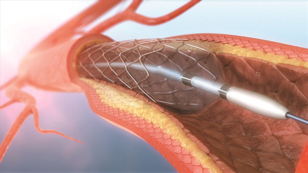 Đặt Stent động mạch vành.