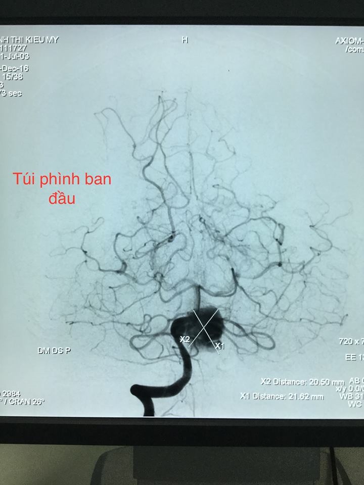 Hình ảnh túi phình ban đầu của bệnh nhân