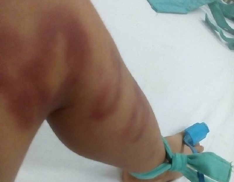 Cháu L đang được các bác sĩ tích cực điều trị tại bệnh viện. Ảnh: PL.
