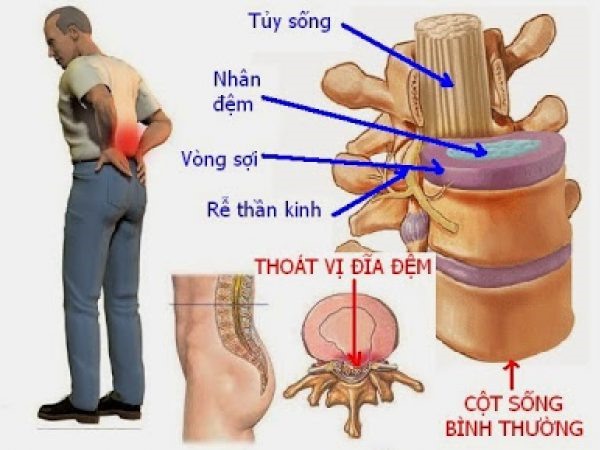 Biến chứng bại liệt cột sống thắt lưng