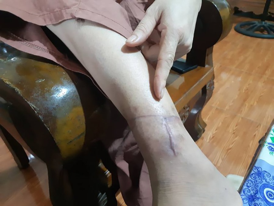 Vết thương ở chân trái khiến chị O đi lại rất khó khăn.