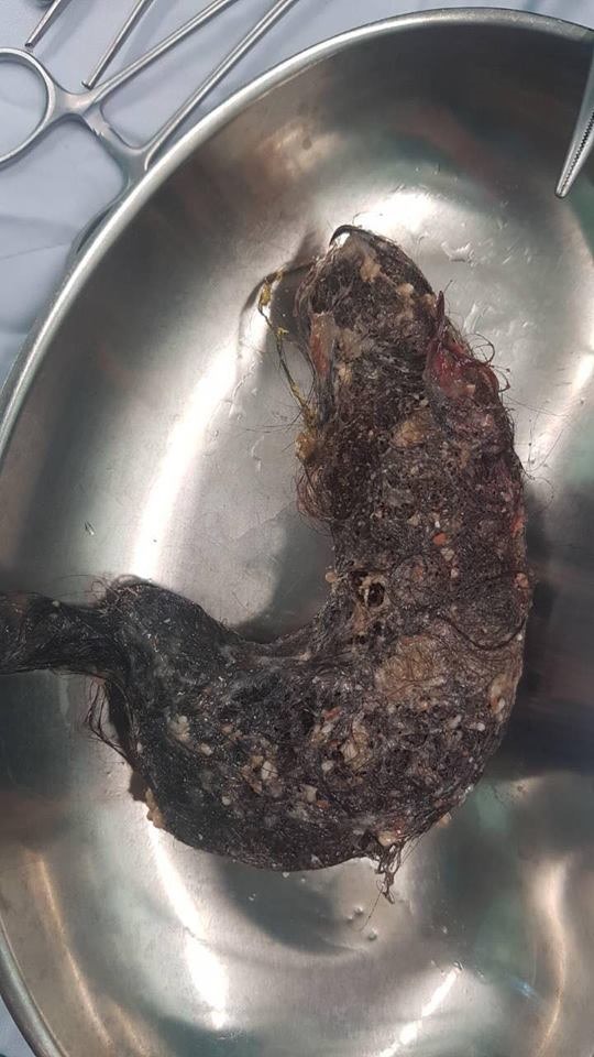 Búi tóc nặng gần 1kg được lấy ra từ cơ thể bệnh nhi