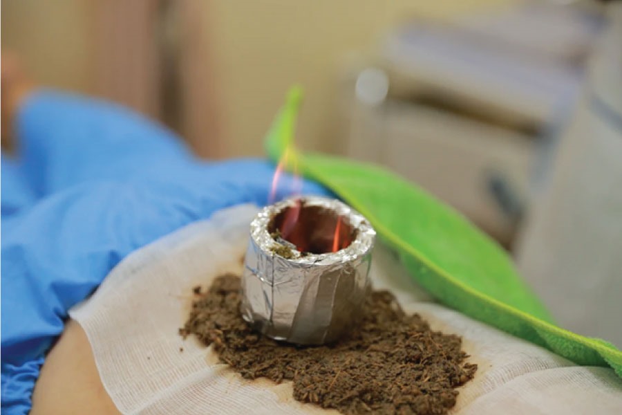 Kỹ thuật dùng ống tre điều trị thoát vị đĩa đệm cột sống