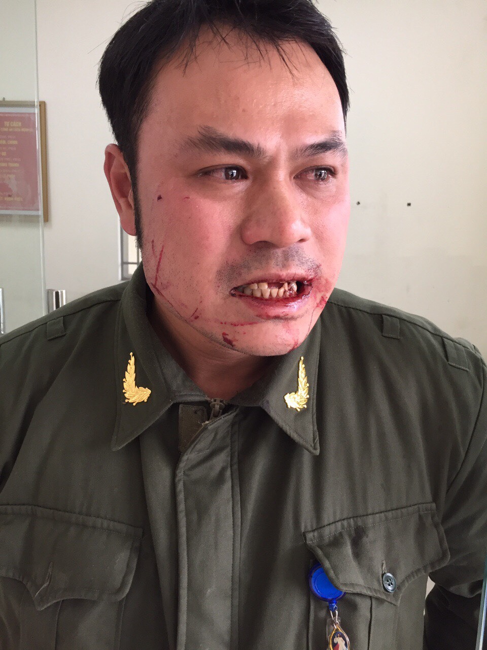Anh Điệp bị xây xát, gãy 4 răng cửa.