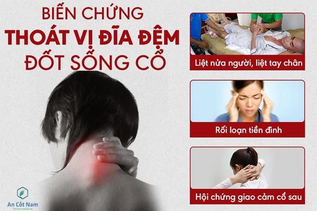 Những biến chứng nguy hiểm của bệnh thoát vị đĩa đệm cổ