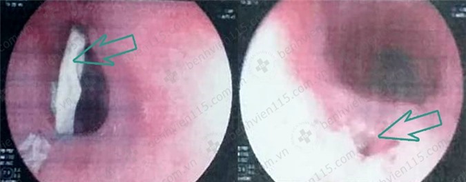 Hình ảnh nội soi thực quản của bệnh nhân: mảnh xương gà (trái) và lỗ thủng thực quản sau khi gắp xương gà ra (phải) Ảnh: BVCC.