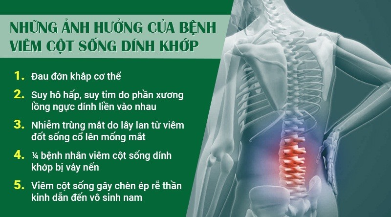 Biến chứng viêm cột sống dính khớp