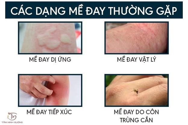 Nổi Mề đay La Gi Nguyen Nhan Triệu Chứng Va Cach Chữa Bệnh Khỏi Hẳn Lao động Online Laodong Vn Tin Tức Mới Nhất 24h