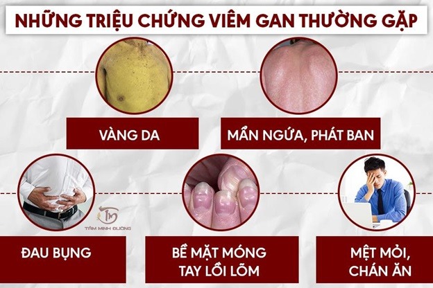 Những triệu chứng bệnh viêm gan điển hình nhất