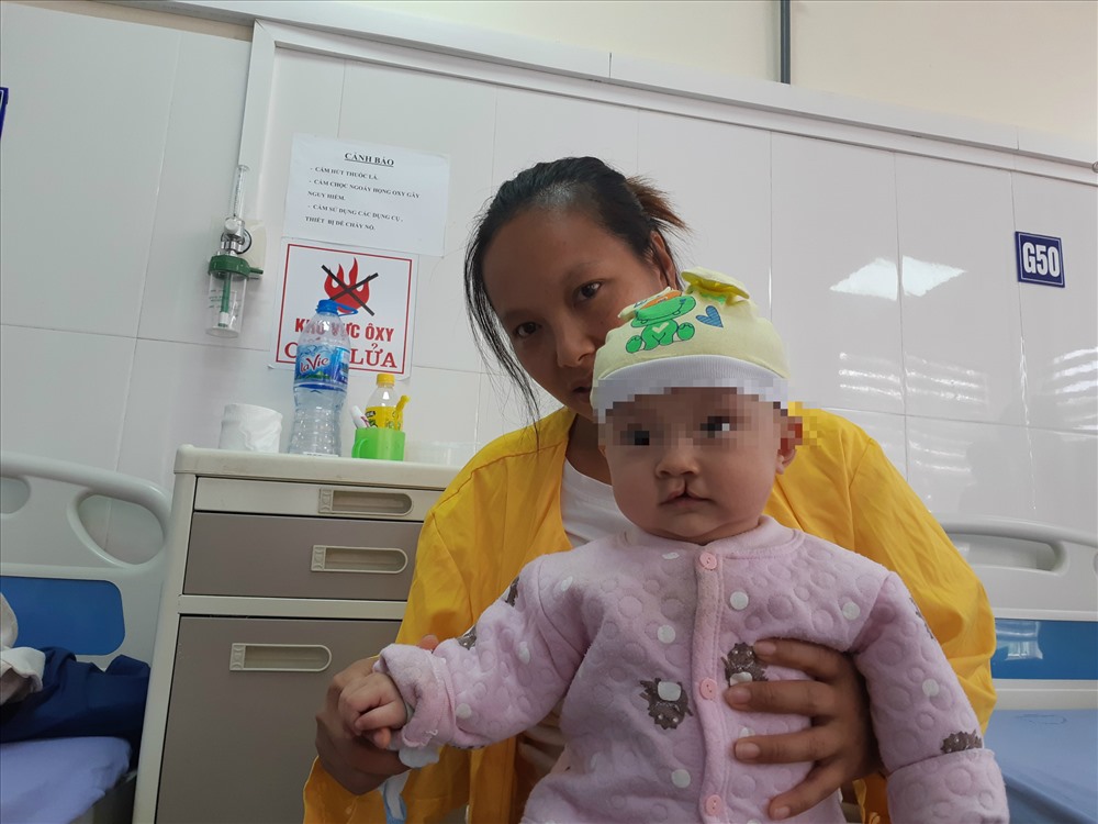 Một em bé bị dị tật khe hở môi vòm miệng. Ảnh: Thùy Linh