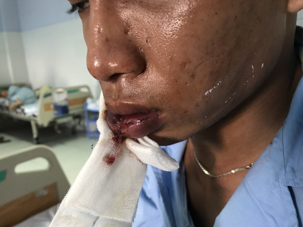 Nhân viên bảo vệ quán bị chém vào miệng