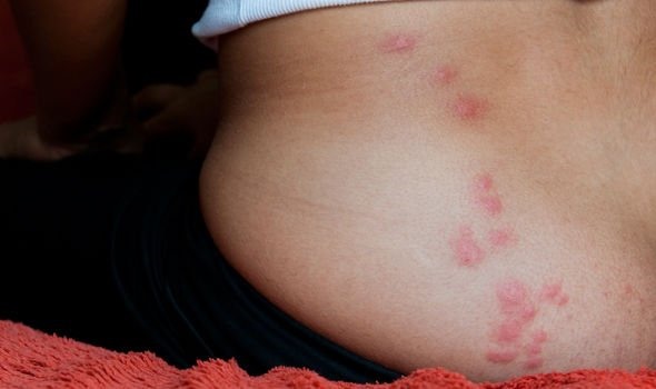 Vết cắn của rệp: Các vết cắn thường ở dạng ngoằn ngoèo (Ảnh: GETTY Images)