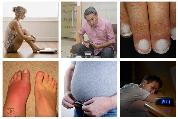 Các triệu chứng xơ gan đặc trưng người bệnh cần chú ý
