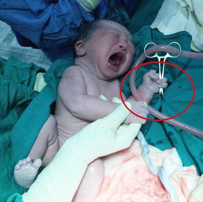 Hay em bé vừa chào đời đã “cướp” kéo của bác sĩ gây chú ý thời gian trước.