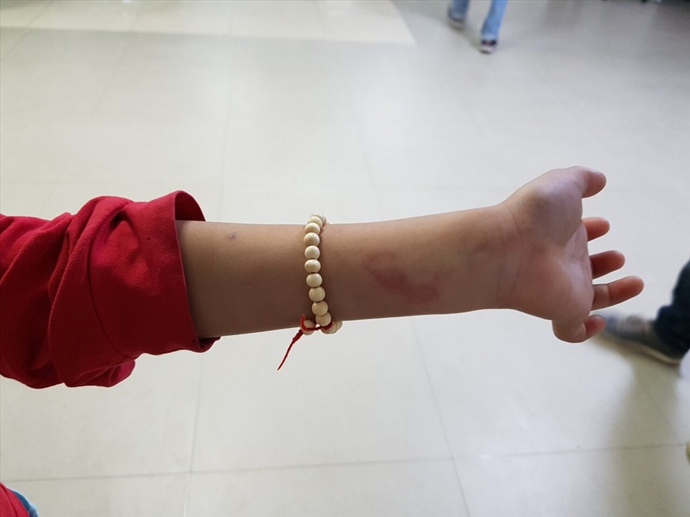 Ngoài vết bầm trên lưng, trên cơ thể cháu còn có các vết bầm tím khác