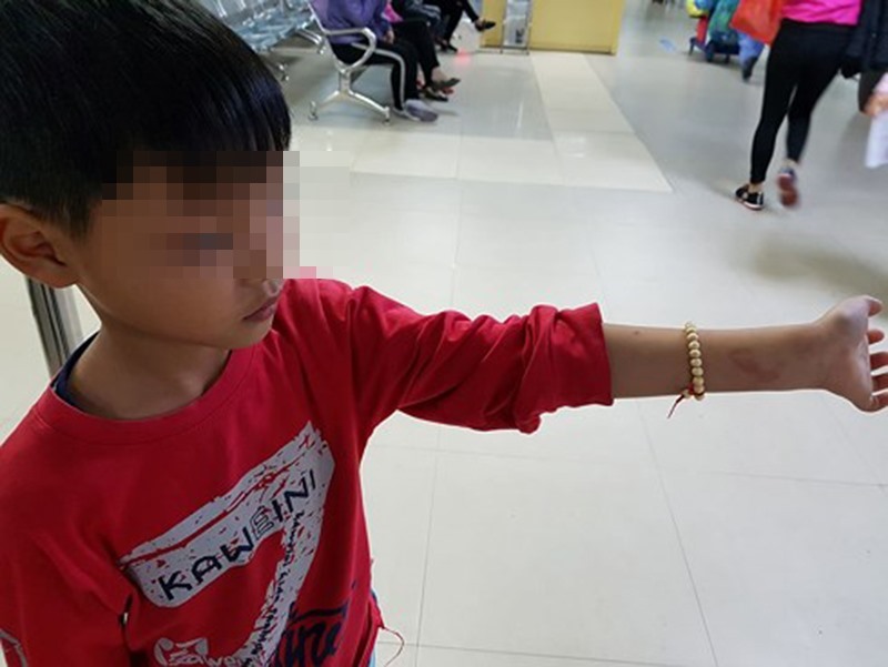 Vết bầm tím trên tay học sinh Phú.