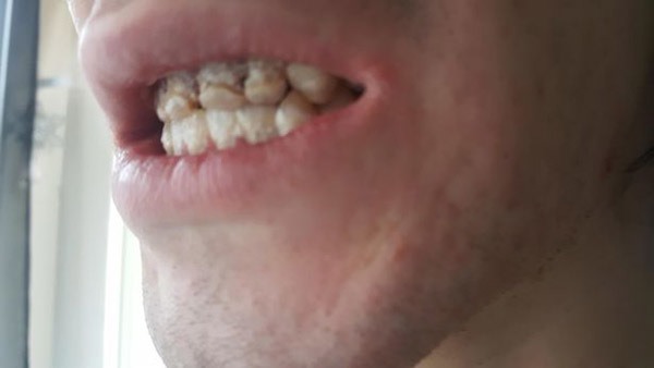 Vinnie Pyner bị mòn răng sau khi uống quá nhiều nước tăng lực.