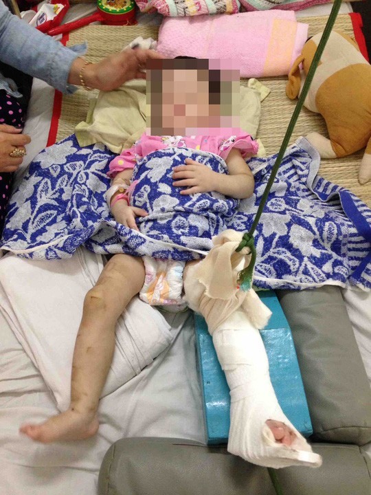 Cháu bé bị đánh gãy chân, đa chấn thương.
