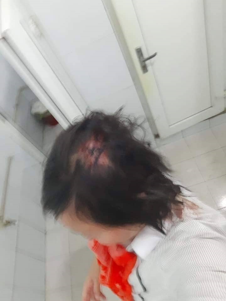 Chị Băng bị chấn thương nhiều vùng trên cơ thể.