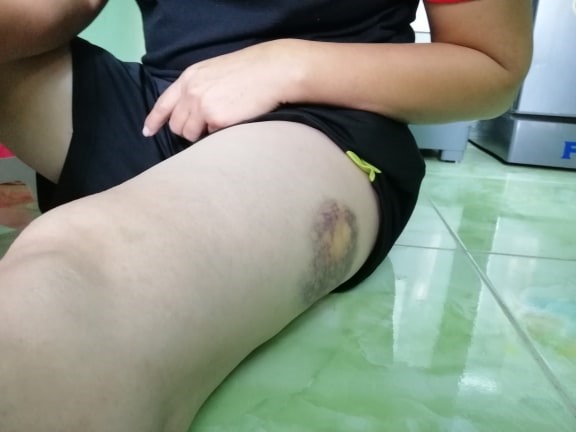 Nạn nhân bị bầm tím nhiều vùng trên cơ thể.