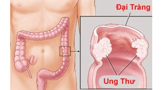 Vị trí của đại tràng.