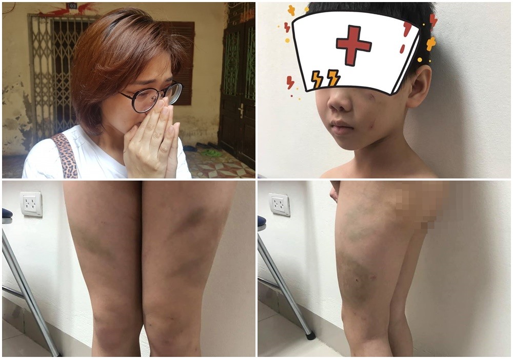 Nhiều vết bầm tím trên cơ thể cháu L.