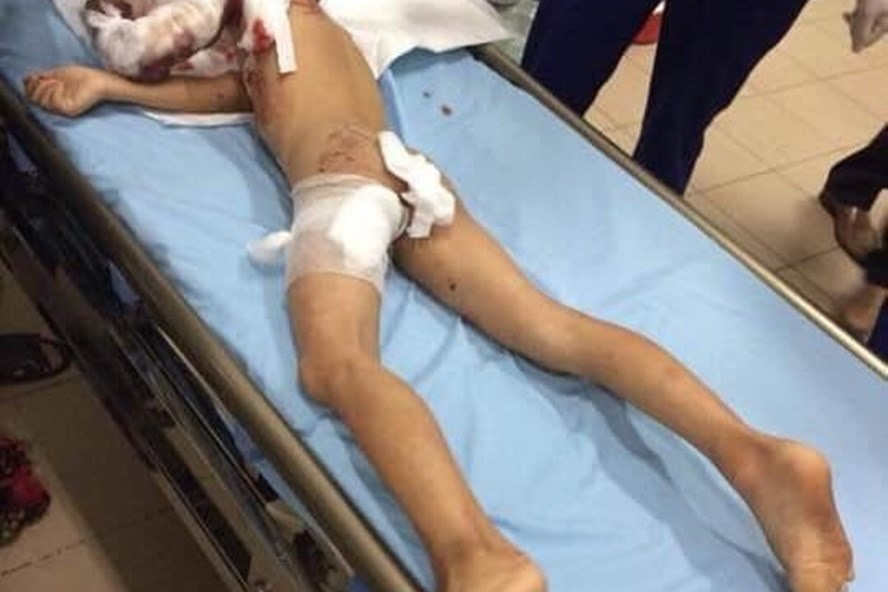 Bé trai 7 tuổi ở Thái Nguyên bị chó nhà tấn công.