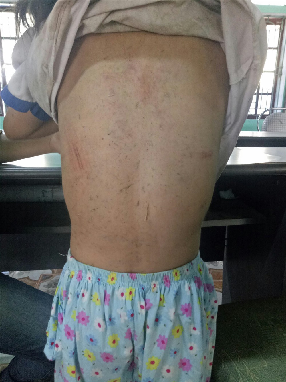 Nhiều vết chầy xước trên người cháu H.