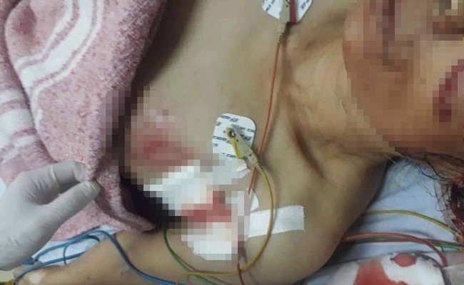 Nữ lao công nhập viện trong tình trạng nguy kịch, nguyên nhân bị một con chó do học sinh nuôi trong khu ký túc xá tấn công
