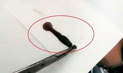 Con đĩa được gắp ra từ mũi bệnh nhân N.