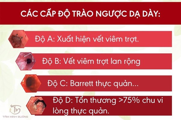 Trào ngược dạ dày là căn bệnh nguy hiểm, người bệnh cần chú ý