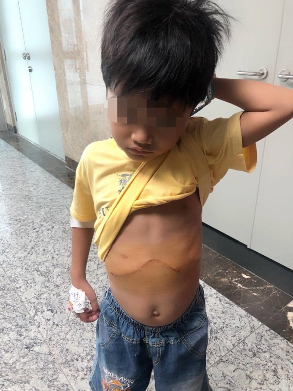 Sau phẫu thuật, bé trai đã khỏe, ảnh BV Nhi Đồng TP Sau phẫu thuật, bé trai đã khỏe, ảnh BV Nhi Đồng TP