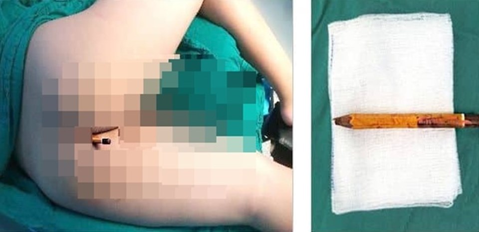 Bút chì đâm xuyên mông trẻ 9 tuổi. Ảnh: Bệnh viện cung cấp Bút chì đâm xuyên mông trẻ 9 tuổi. Ảnh: Bệnh viện cung cấp