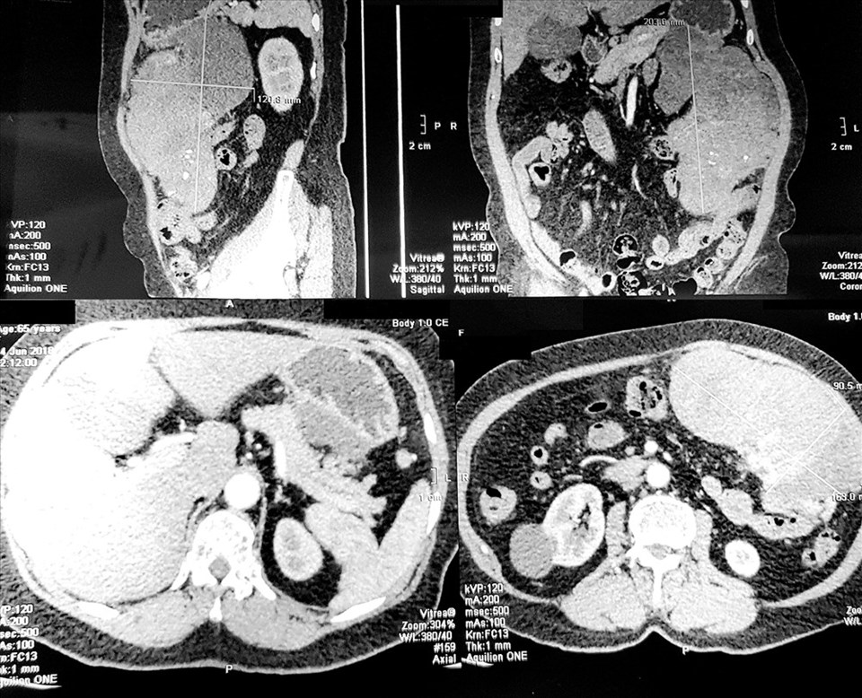 CT Scan- hình ảnh khối bướu rất lớn trong ổ bụng. CT Scan- hình ảnh khối bướu rất lớn trong ổ bụng.