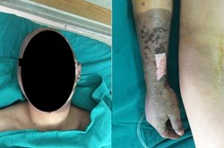 Cận Tết Âm lịch, kinh hoàng những vụ bỏng nặng do làm pháo tự chế