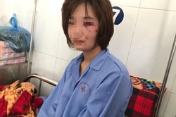 Nữ phục vụ xe buýt bị 4 "ma men" hành hung: Họ nói "đánh thế vẫn còn nhẹ"