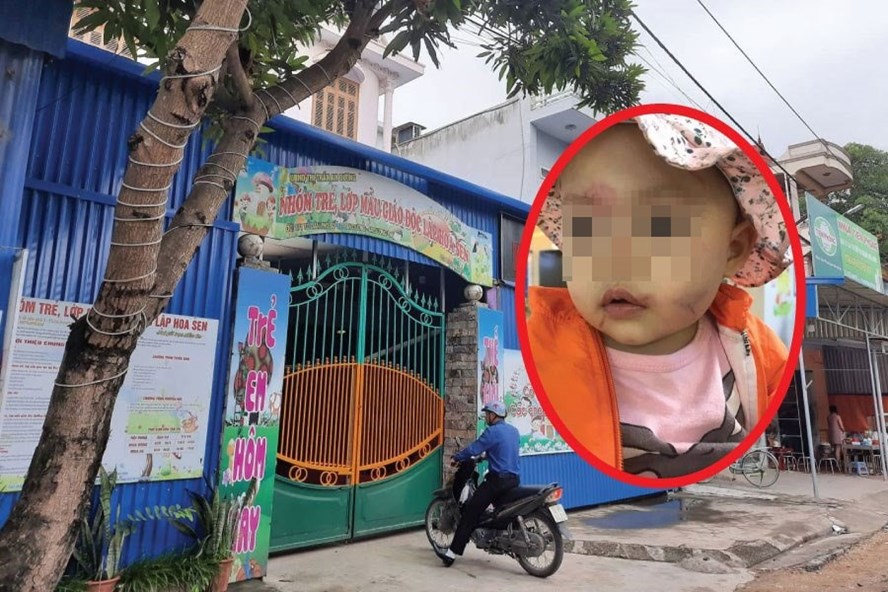 Hải Phòng: Cháu bé 14 tháng tuổi mặt bị bầm tím ngay buổi đầu tiên đến lớp hai phong chau be 14 thang tuoi mat bi bam tim ngay buoi dau tien den lop