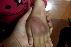 Rùng mình trước những vết thương của bé gái lớp 2 bị bố đánh dã man