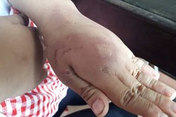 Bé gái 8 tuổi bị bố đánh dã man vì học kém hơn anh trai